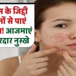 Skin Care Tips: पिंपल्स के जिद्दी निशानों से पाएं छुटकारा! एक्सपर्ट के बताए ये असरदार नुस्खे आज़माएं