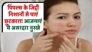 Skin Care Tips: पिंपल्स के जिद्दी निशानों से पाएं छुटकारा! एक्सपर्ट के बताए ये असरदार नुस्खे आज़माएं