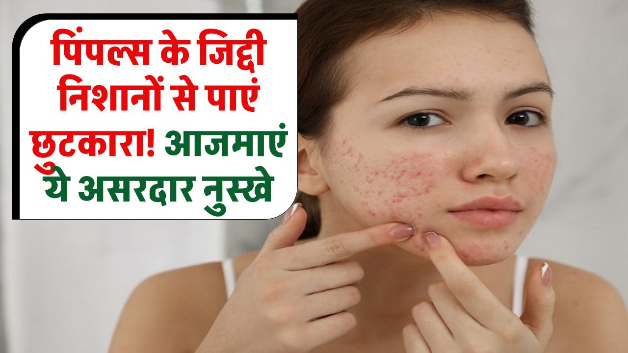 Skin Care Tips: पिंपल्स के जिद्दी निशानों से पाएं छुटकारा! एक्सपर्ट के बताए ये असरदार नुस्खे आज़माएं