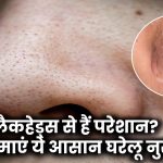 Skin Care Tips: ब्लैकहेड्स से हैं परेशान? आज़माएं ये आसान घरेलू नुस्खे और पाएं साफ-सुथरी स्किन!