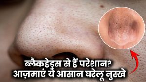 Skin Care Tips: ब्लैकहेड्स से हैं परेशान? आज़माएं ये आसान घरेलू नुस्खे और पाएं साफ-सुथरी स्किन!