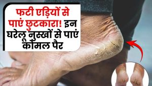 Crack heel home remedy: फटी एड़ियों से छुटकारा! इन आज़माए हुए घरेलू नुस्खों से पाएं कोमल पैर