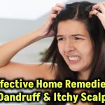 10 Home Remedies for Dandruff and Itchy Scalp That Work