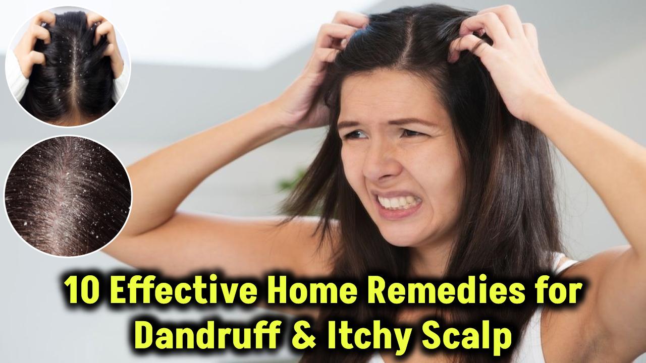 10 Home Remedies for Dandruff and Itchy Scalp That Work