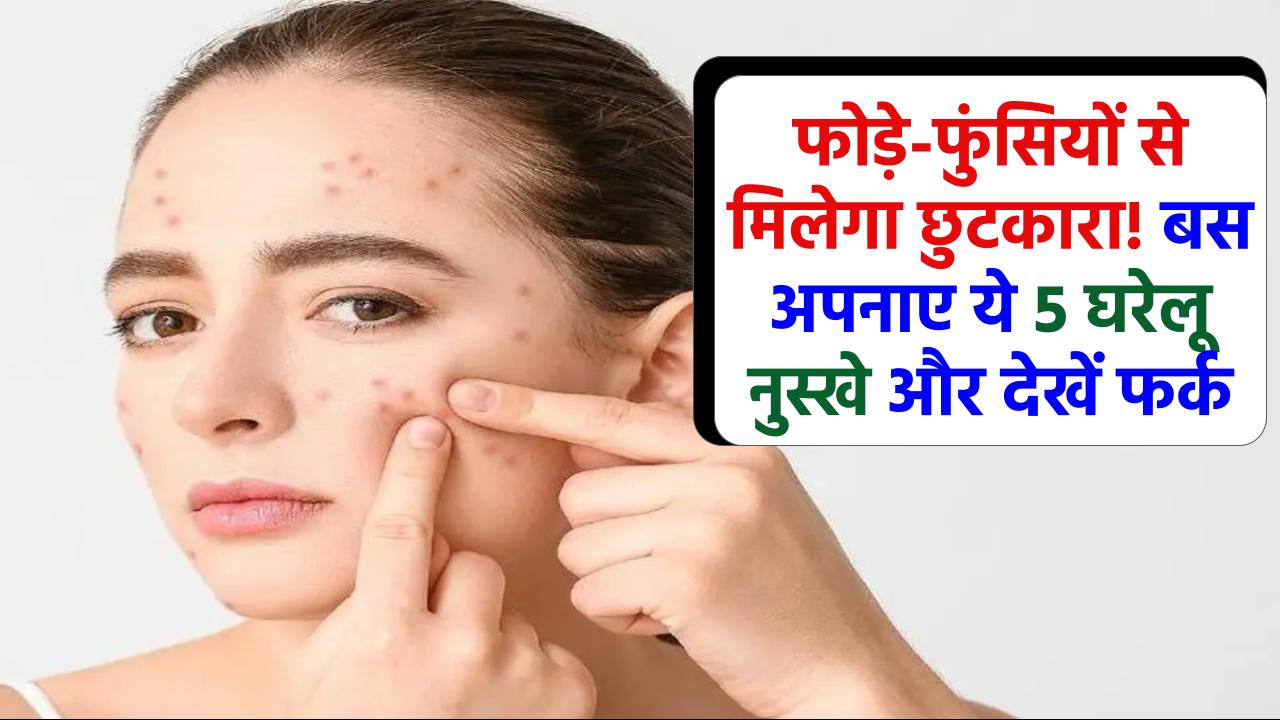 फोड़े-फुंसियों से छुटकारा बस एक रात में! ये 5 घरेलू नुस्खे लगाएं और सुबह पाएं साफ़-सुथरी स्किन