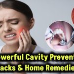 7 Powerful Home Remedies For Tooth Cavity