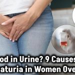 Blood In Urine Causes In Women