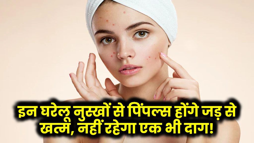 Home Remedies for Acne: इन घरेलू नुस्खों से पिंपल्स होंगे जड़ से खत्म, नहीं रहेगा एक भी दाग!