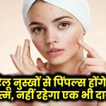 Home Remedies for Acne: इन घरेलू नुस्खों से पिंपल्स होंगे जड़ से खत्म, नहीं रहेगा एक भी दाग!