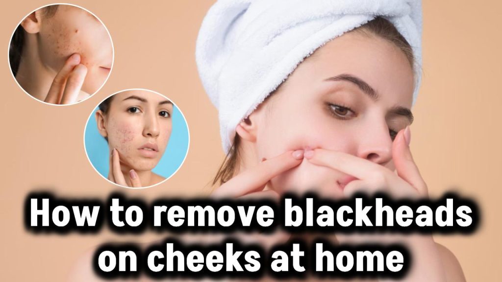 How to remove blackheads on cheeks at home