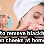 How to remove blackheads on cheeks at home