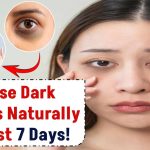 How to remove dark circles under eyes naturally