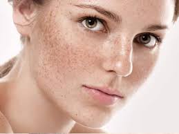 Hyperpigmentation