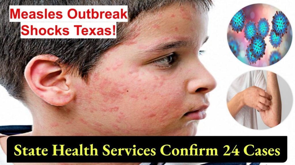 measles-outbreak-texas-24-cases-risk