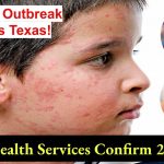 measles-outbreak-texas-24-cases-risk