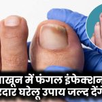 Toe Nail Fungus Home Remedies: नाखून में फंगल इंफेक्शन? ये असरदार घरेलू उपाय जल्द देंगे राहत!