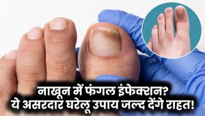 Toe Nail Fungus Home Remedies: नाखून में फंगल इंफेक्शन? ये असरदार घरेलू उपाय जल्द देंगे राहत!