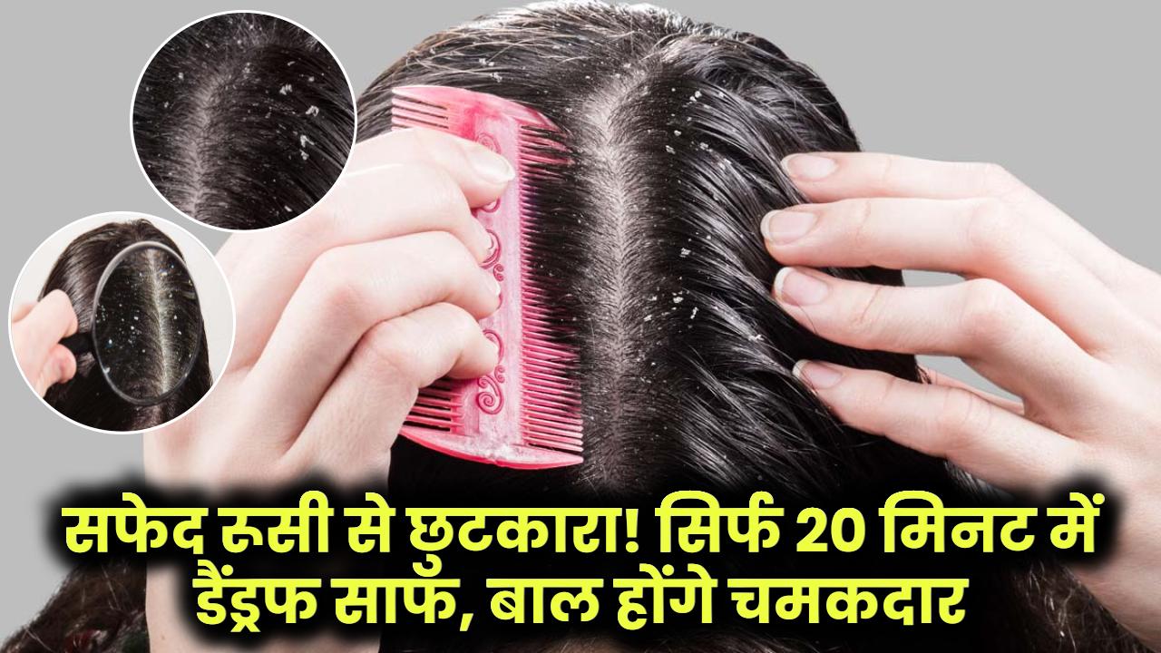 सफेद रूसी से छुटकारा! सिर्फ 20 मिनट में डैंड्रफ साफ, बाल होंगे चमकदार