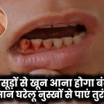 Gum Bleeding Remedies: मसूड़ों से खून आना होगा बंद! इन आसान घरेलू नुस्खों से पाएं तुरंत राहत!