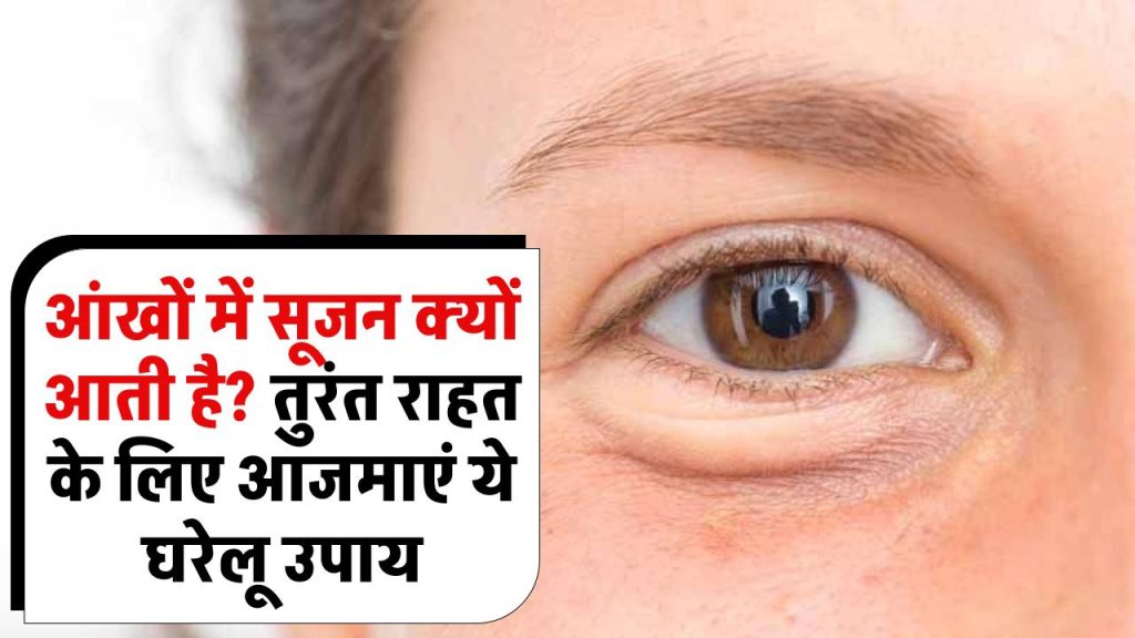 Eye Swelling: आंखों में सूजन क्यों आती है? जानिए कारण और तुरंत राहत के लिए आजमाएं ये घरेलू उपाय