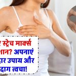 स्तनों पर स्ट्रेच मार्क्स से हैं परेशान? अपनाएं ये असरदार उपाय और पाएं बेदाग त्वचा! घरेलू नुस्खों और नेचुरल ट्रीटमेंट दिखेगा असर? अभी पढ़ें!