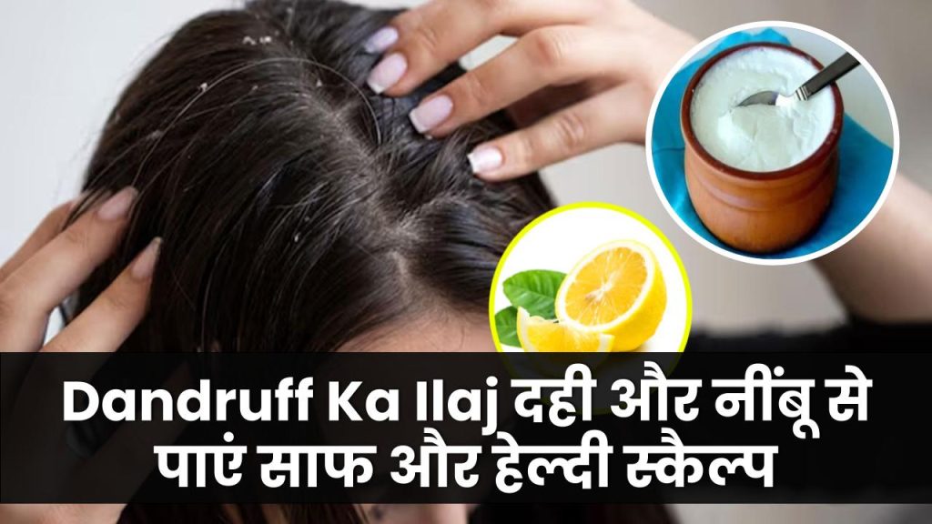 Dandruff Ka Ilaj: दही और नींबू से पाएं साफ और हेल्दी स्कैल्प