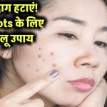 Dark Spots हटाने के घरेलू उपाय – चेहरे के दाग-धब्बों को हल्का करने के लिए अपनाएं ये Best Remedies