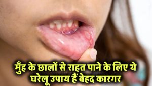 Mouth Ulcer Treatment: मुँह के छालों से राहत पाने के लिए ये घरेलू उपाय हैं बेहद कारगर