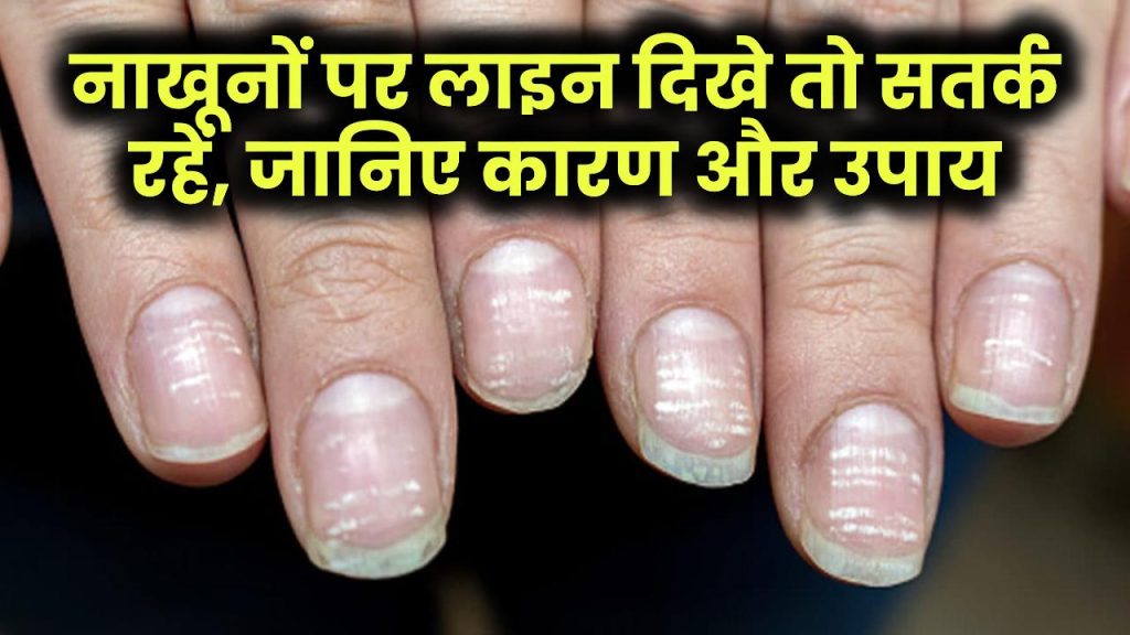 नाखूनों पर दिखें ऐसी लाइन तो सावधान! जानिए इसके कारण और आसान उपाय