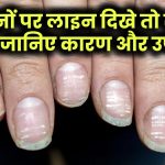 नाखूनों पर दिखें ऐसी लाइन तो सावधान! जानिए इसके कारण और आसान उपाय