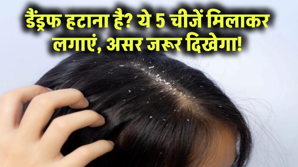 डैंड्रफ का सफाया चाहते हैं? इन 5 चीजों को मिलाकर लगाएं, दिखेगा कमाल का फर्क