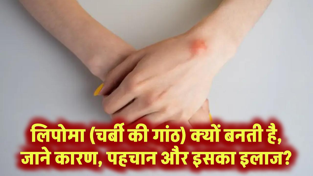 Lipoma in Hindi: लिपोमा (चर्बी की गांठ) क्यों बनती है, कैसे पहचानें और क्या है इसका इलाज?