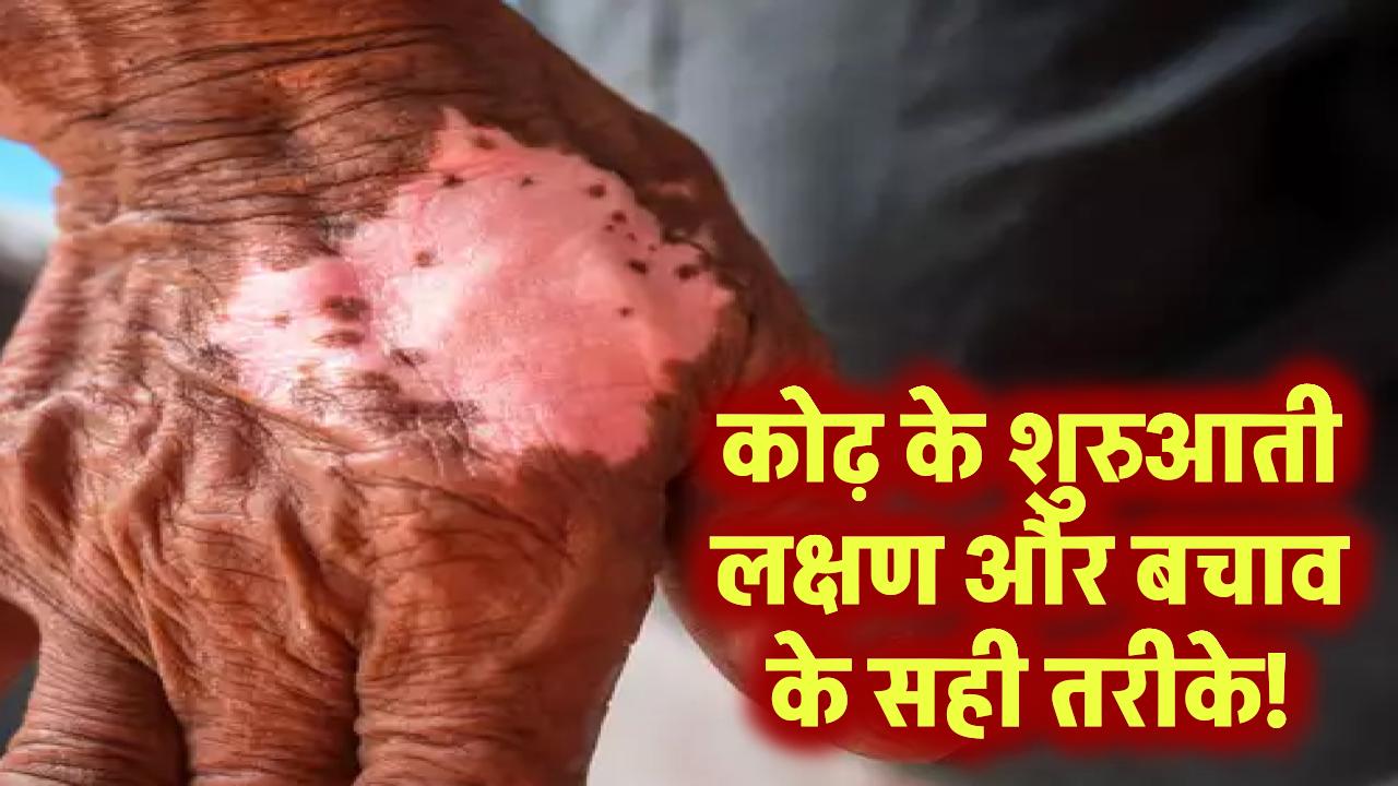 कोढ़ की बीमारी की शुरुआत ऐसे होती है! जानिए पहले लक्षण और बचाव के सही तरीके