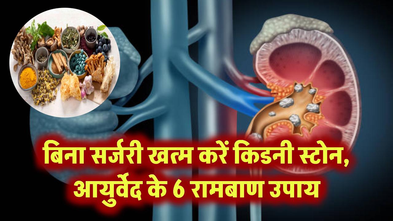 बिना सर्जरी घुल जाएंगे किडनी स्टोन! जानिए आयुर्वेद डॉक्टर के 6 रामबाण उपाय