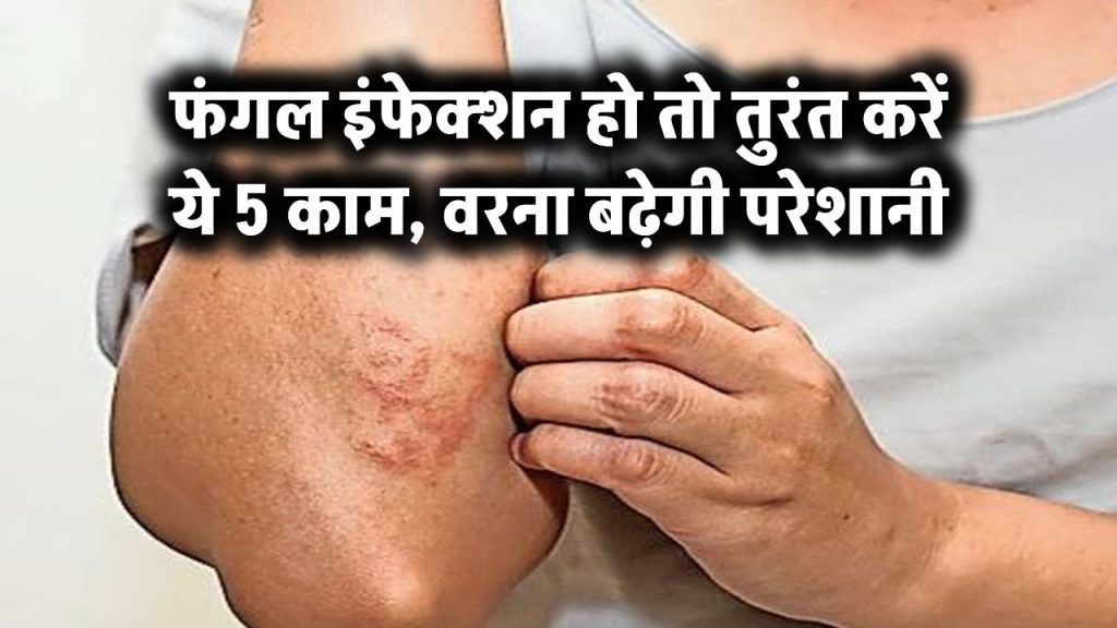 फंगल इंफेक्शन हो तो तुरंत करें ये 5 काम – वरना बढ़ेगी परेशानी