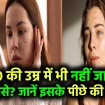 30 की उम्र में भी नहीं जा रहे मुंहासे? जानिए इसके पीछे की असली वजह