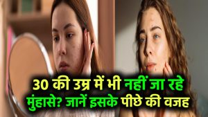 30 की उम्र में भी नहीं जा रहे मुंहासे? जानिए इसके पीछे की असली वजह