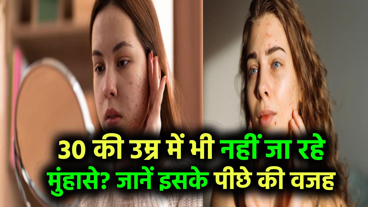30 की उम्र में भी नहीं जा रहे मुंहासे? जानिए इसके पीछे की असली वजह