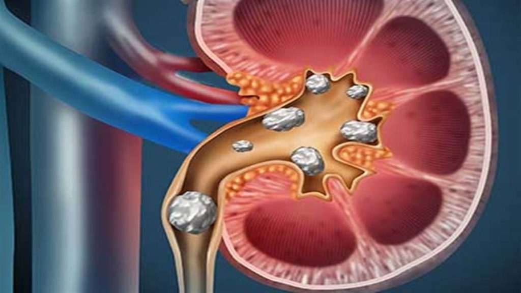 kidney stone